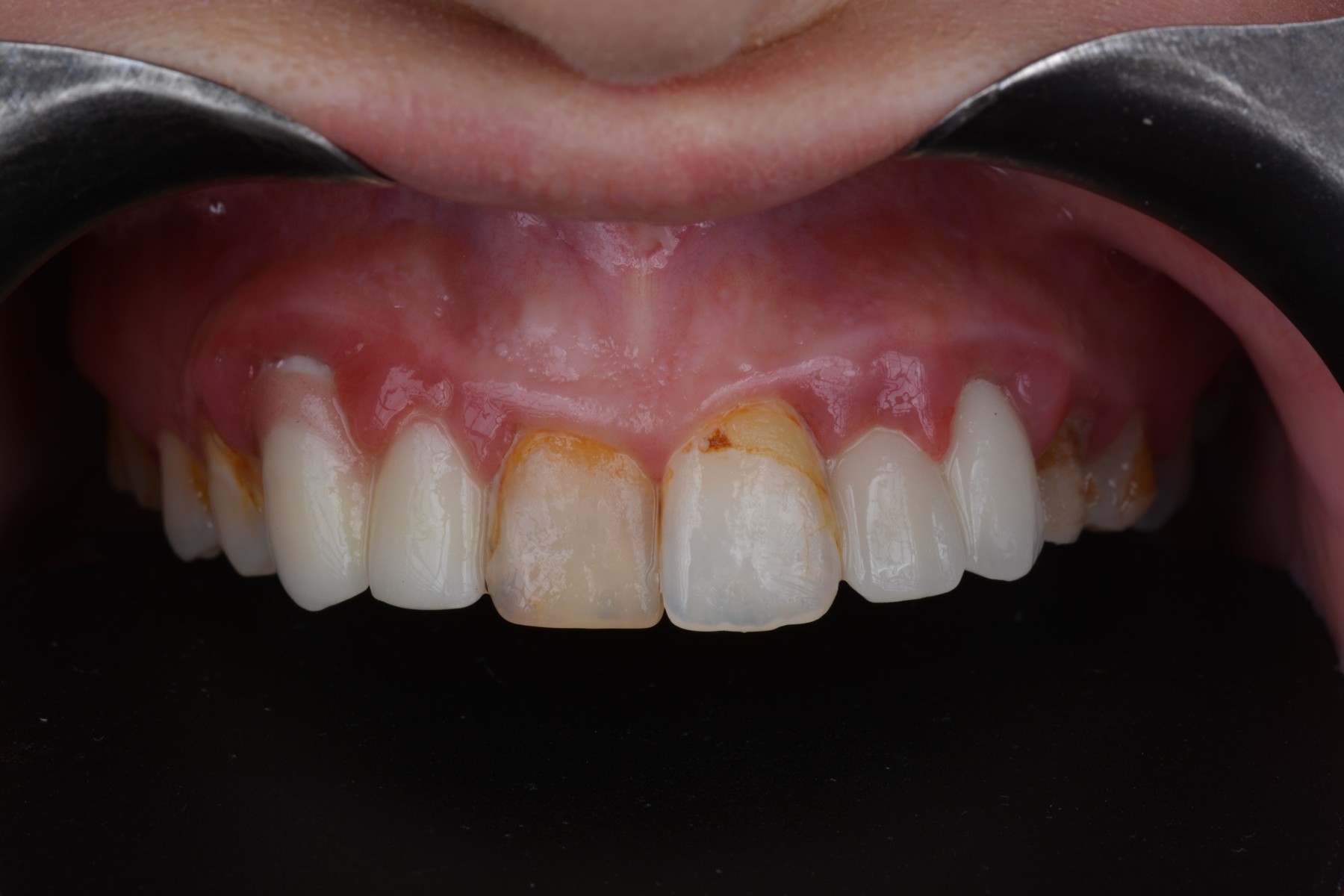 Biomimetic Zirconia Reconstruction - BEFORE // INITIAL STATE