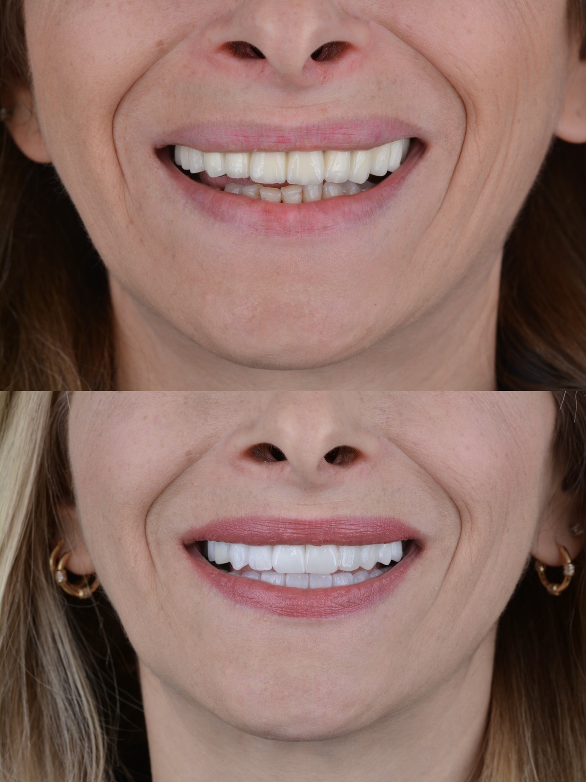 Full Mouth Rehabilitation: All-on-X (12 Implants) - Before and After Smile Transformation