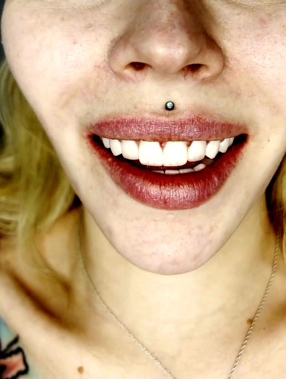 Post-Cementation Smile Reveal in Clinical Chair