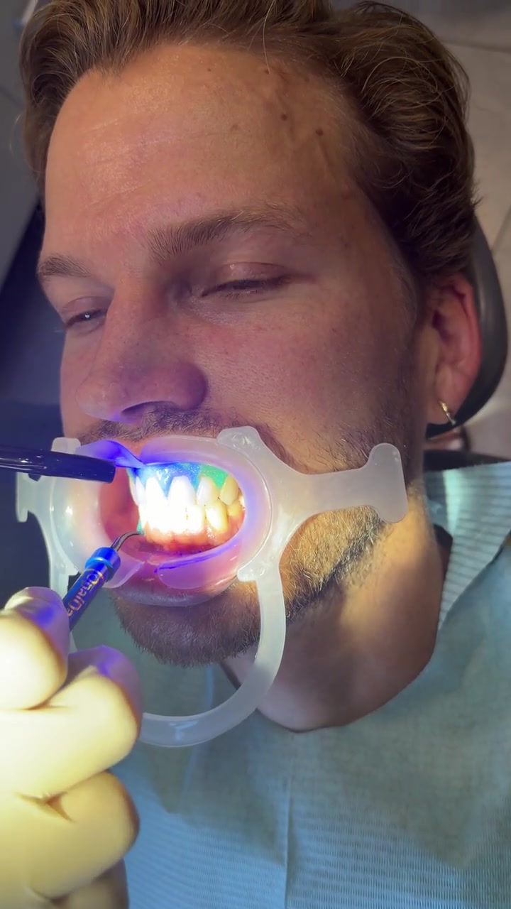 LED-Activated In-Office Teeth Whitening